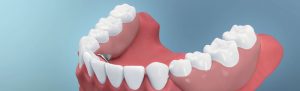 Längeres Leben durch Zahnprothesen?