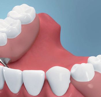 Längeres Leben durch Zahnprothesen?